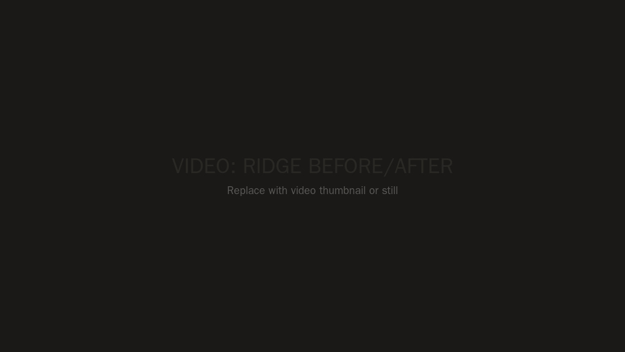 Ridge removal comparison